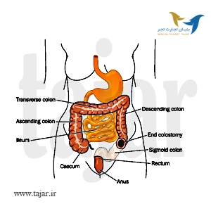 COLOSTOMY