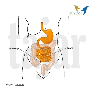 Ileostomy