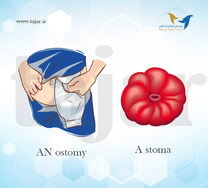 Ostomy Bag​
