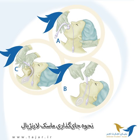 نحوه جای گذاری ماسک لارنژیال