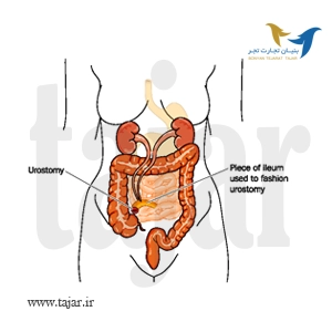 جراحی UROSTOMY